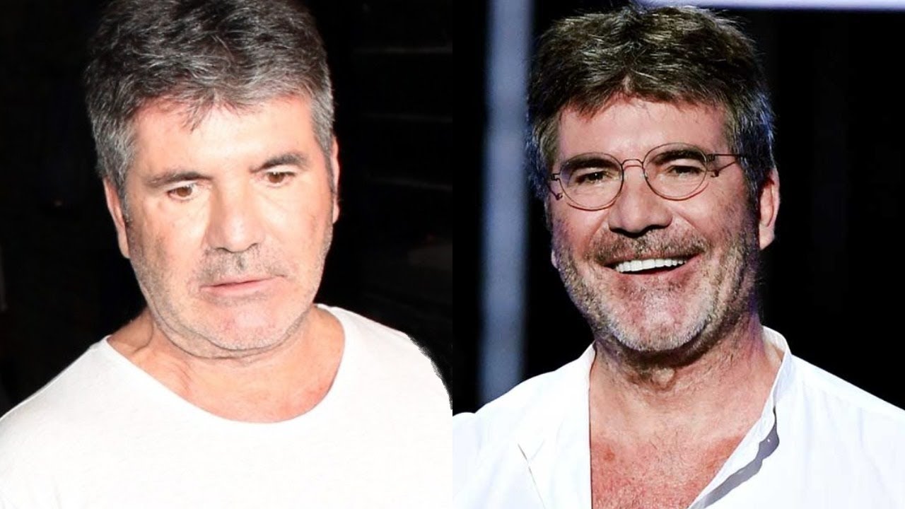 Simon Cowell removes face fillers saying it’s too much