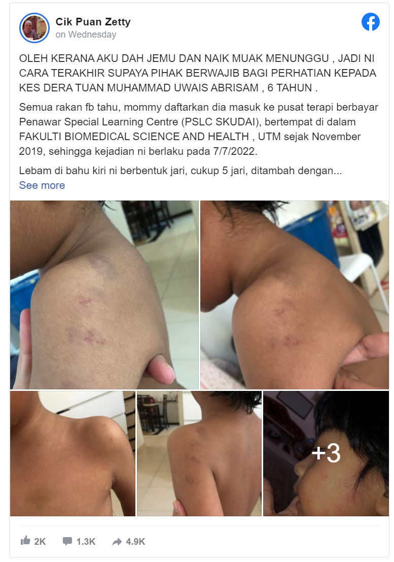 Police get cracking on abuse complaints after Johor mum virals pictures of autistic son's bruised body